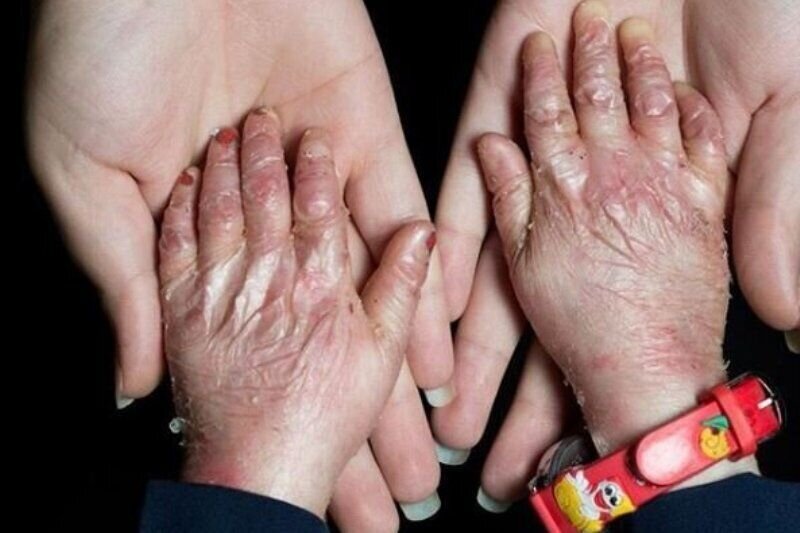 پرداخت ۱۳.۵ میلیون تومان کمک هزینه به هر بیمار پی‌کی‌یو در سال گذشته