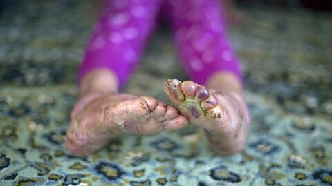 رسانه | حمایت مستمر از بیماران اوتیسم، پروانه‌ای و پی‌کی‌یو در اسدآباد